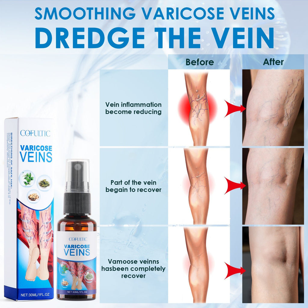 30ml Varicose Vein Spray Multi - Purpose Knee And Leg Care Spray Promote Blood Circulation - Beautybuzz